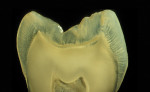 Figure 1B  These tooth sections depict the varying thicknesses of the enamel according tothe shape of the tooth and its location on the crown (Figure 1A courtesy of Dr. Stephan J. Paul; Figure 1Bcourtesy of Dr. Didier Dietschi).
