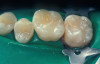 Fig 1. Edentulous patient treated with a MAD (SUAD Herbst appliance, strongdental.com). The upper component is fit and contoured similar to the patient’s full upper denture. The lower component is retained by two dental implants with Locator® abutments (zestdent.com).