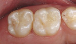 Figure 8C: The occlusal surfaces were restored with an etch-and-rinse adhesive and ananohybrid composite resin.j