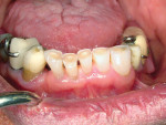 Figure 10  This view shows moderate to severe incisal wear of the mandibular anterior teeth.
