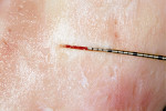 Figure 4  Precision cut less than 1 mm made with bone saw-like insert that has a width of 0.55 mm. For comparison, the pictured periodontal probe tip is 0.6 mm.