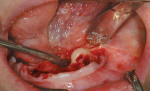 Figure 10A  Torus removal with Piezosurgery saw-like insert. A Exposure of torus. B Incision being completed. C Separation of torus by osteotomy with bone saw-like insert.