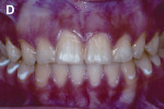 Figure 1d  One month after dental enamel microabrasion.