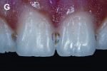 Figure 1g  Removal of enamel white stains in the buccal and proximal aspects of maxillary anterior teeth.