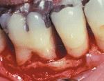 Figure 3  Vertical defect exposed at surgery.