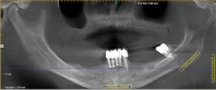 The Latest Advancement in Fixed Full-Arch Restorations Webinar Thumbnail