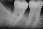 Figure 1  X-ray shows bone loss on the distal aspect and in the area of the furcation of tooth No. 31.