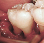 Figure 3  Surgical photograph of bone loss in tooth No. 31 buccally and distally.