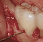 Figure 4  2-year reentry of tooth No. 31 showing complete bone fill in the furcation and distal intrabony defect.