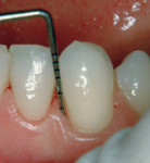 Figure 6  10 years post-regenerative therapy tooth No. 22 CPAL was 3 mm (gain of 6 mm CPAL).