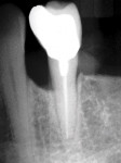 Figure 7  Pretreatment radiograph of tooth No. 21 with bony defect on mesial.