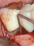 Figure 12  Surgical photograph of an intrabony defect on the mesial of tooth No. 31.