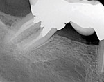 Figure 14  8-year postoperative radiograph of tooth No. 31 with bone fill on the mesial.