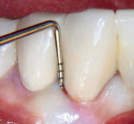 Figure 15  Clinical appearance of tooth No. 27 with CPAL of 7 mm.