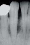 Figure 21   Radiograph of tooth No. 27showing extensive bone loss on the mesial.