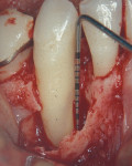 Figure 22  Surgical photograph depicting bone loss on the buccal and mesial aspects of tooth No. 27.