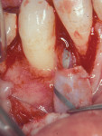 Figure 23  GTRmembrane removal shows new tissue 6 weeks following surgery on tooth No. 27.