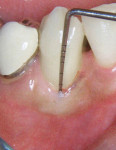 Figure 24  9-year postoperative clinical photograph shows tooth No. 27 with a 2-mm PD.