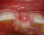 Figure 3  Facial bone resorption resulting in loss of tissue contour is common where ridge preservation was not incorporated into the extraction procedure.