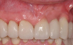 Figure 8  Clinical appearance of the ceramic fixed partialdenture: superficial application of pink composite allowed color blending with the surrounding gingival framework.