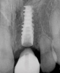 Figure 13  Implant placement in the site No. 9.Blunted root apices on Nos. 8 and 10 associated with prior orthodontic treatment.