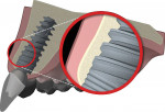 Figure 14  Graphic illustration demonstrating the need for ideal bone volume, including at least 2 mm of bone on the facial of the implant. This is an important factor to stabilize both facial and interproximal gingival tissues.