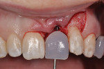 Figure 15  Implant site preparation through a 3-dimensionally correct surgical guide. Note that flap access was used in order to bone graft the facial of the implant.