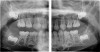 A severely resorbed upper ridge with oral-antral communication.