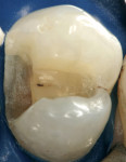 Figure 1b  The adhesive preparation for composite restorations allows a more conservative design than its amalgam counterpart.