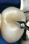 Figure 2h  A final increment of natural translucent shaded hybrid composite was placed, and the occlusal anatomy was developed with a burnisher.<sup>c</sup>