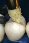 Figure 2i  A variety of acceptable polishing protocols exist to impart a natural luster to composite restorations.