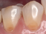 Figure 3a  The direct bonding duo-shade technique is used in cases where noncarious cervical lesions are present (eg, saucer–shaped noncarious cervical lesions on the mandibular right premolars).