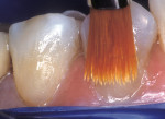 Figure 3b  To correct this condition, the initial dentin layer was applied, then a second translucent enamel layer was smoothed cervico-incisally with a sable brush.