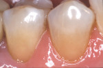 Figure 3c  The completed composite restorations exhibited bioesthetic integration at the dentogingival interface.