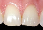 Figure 4a  The direct bonding duo-shade technique can be employed effectively in cases of fractures (eg, fractured maxillary central incisors).
