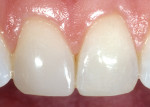 Figure 4c  The composite restorations utilizing the simplified duo-shade placement technique were completed with satisfactory results in a simpler, shorter period of time than would have been the case if another method had been used.