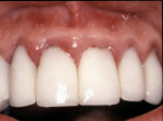 Figure 1  The gingival margins are edematous and erythematous due to disregard of basic  biologic principles. The papillae are crowded out of the embrasure spaces, and ill-fitting margins promote biofilm development. The gingival margin of the right