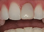 Figure 2  The gingival margin of the direct composite restoration on the maxillary left central incisor exhibited leakage and  discoloration over time.