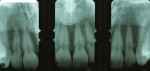 Figure 5b  Analysis of the anterior periapical radiographs and comparison of crown length between the films and intraorally suggests that 2 mm to 3 mm of anatomic crown could be exposed with esthetic crown lengthening.