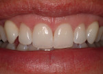 Figure 5c  Final healing demonstrates the dramatic improvement in the appearance of the teeth and smile postoperatively.