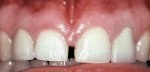 Figure 6a  A patient presented with displeasing diastema and porcelain crowns that had recently been placed on the peg lateral incisors.