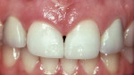 Figure 6b  Post-frenectomy and anterior direct composite bonding, the patient was pleased despite the fact that 