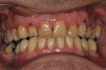 Figure 1  Preoperative view of a fully-retracted smile of a 40-year-old patient with no medical contraindications to the treatment plan. After examination, the authors selected an initial average shade.