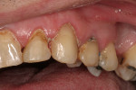 Figure 4  Caries control was performed on tooth No. 11. In this procedure, a lighter shade was selected to match the tooth after the whitening process.