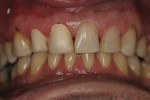 Figure 6  Caries control was performed on teeth Nos. 9 and 10 during whitening treatment due to sensitivity.
