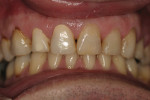 Figure 8  Whitening treatment resumed on day 10.