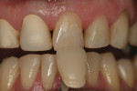 Figure 9  Final shade selection for crowns and composite restorations was made after two weeks post-bleaching treatment.