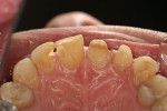 Figure 11  Lingual view of prepared teeth at the time of the patient's final visit.