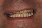Figure 16  As evident from this preoperative maxillary arch view of the patient's smile, considerable work was needed.