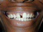 Figure 2  Unretracted view of the patient's smile. Note the dark color of the right central incisor and large diastema between teeth Nos. 8 and 9.